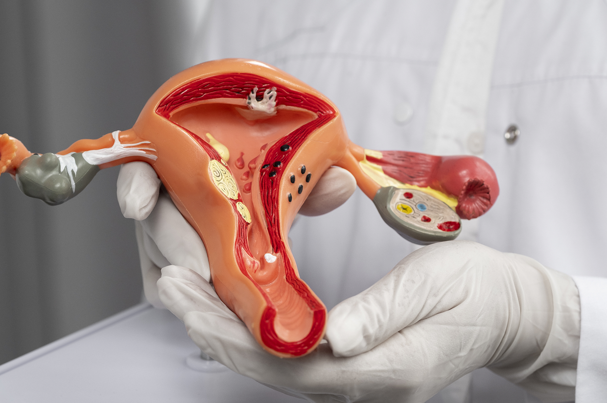 Polycystic Ovary Syndrome (PCOS)
